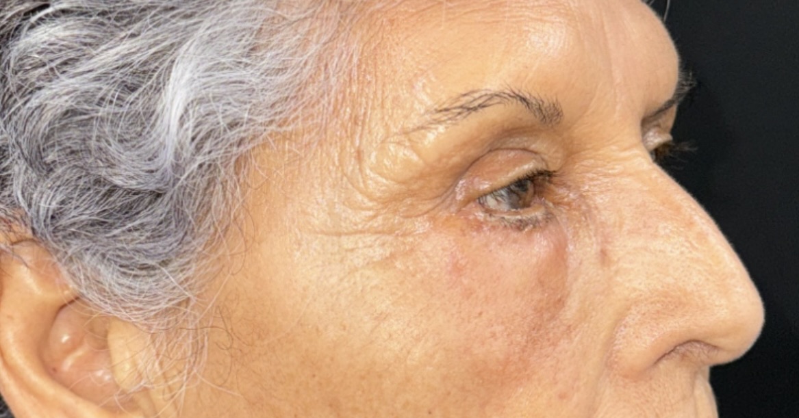 After Image: Eyelid Surgery - right-front-oblique