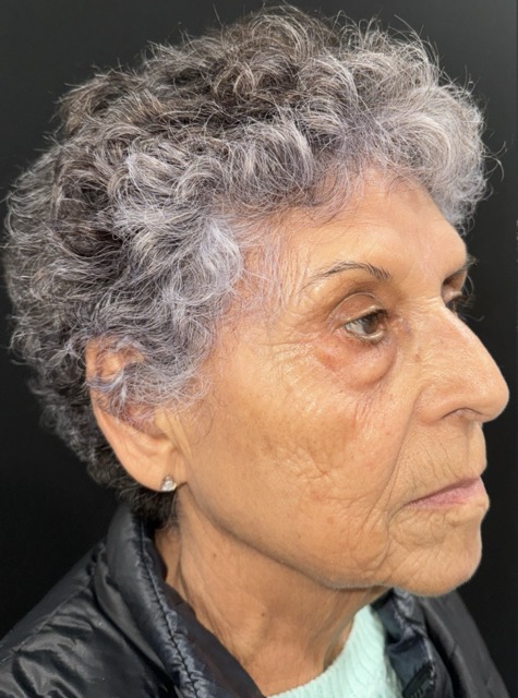 Before Image: Facial Fat Transfter - right-front-oblique