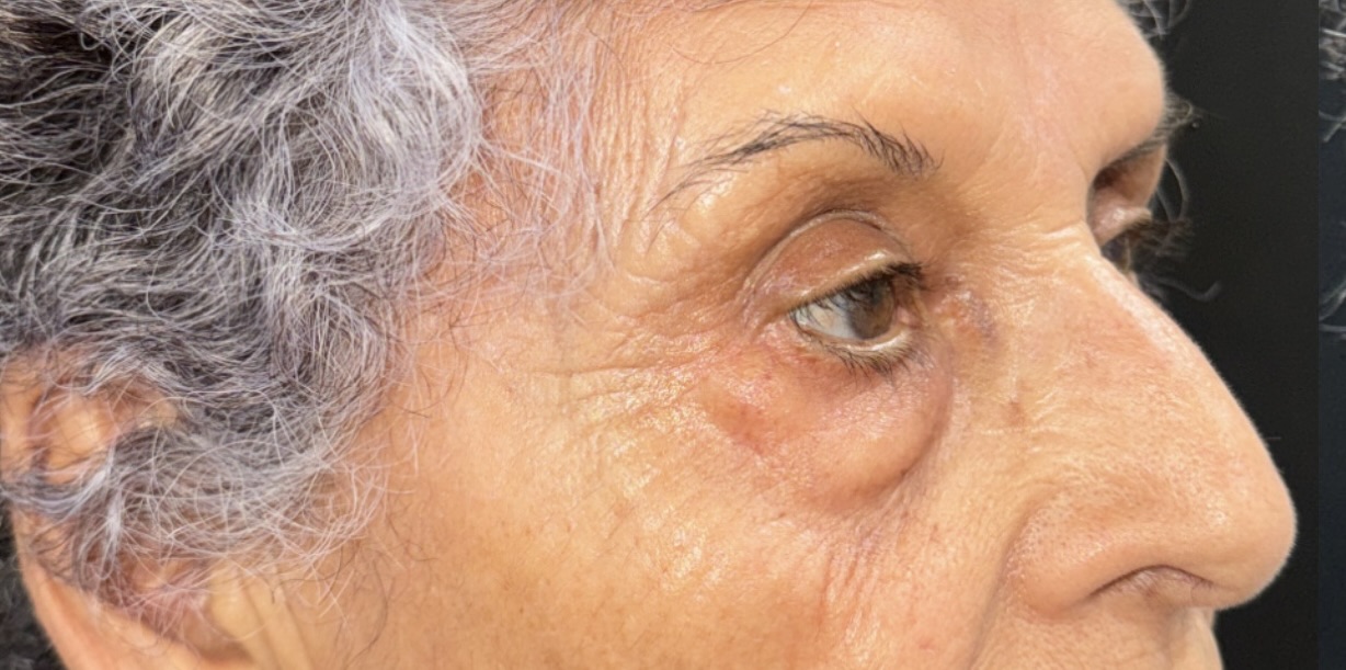 Before Image: Eyelid Surgery - right-front-oblique