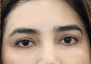 After Image: Eyelid Surgery
