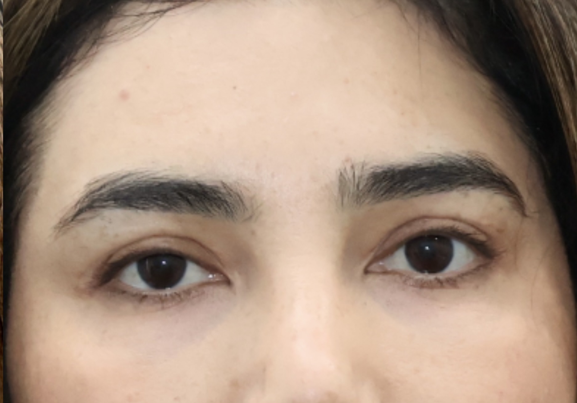 After Image: Eyelid Surgery - front