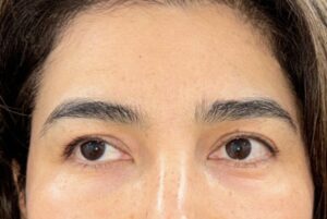 Before Image: Eyelid Surgery