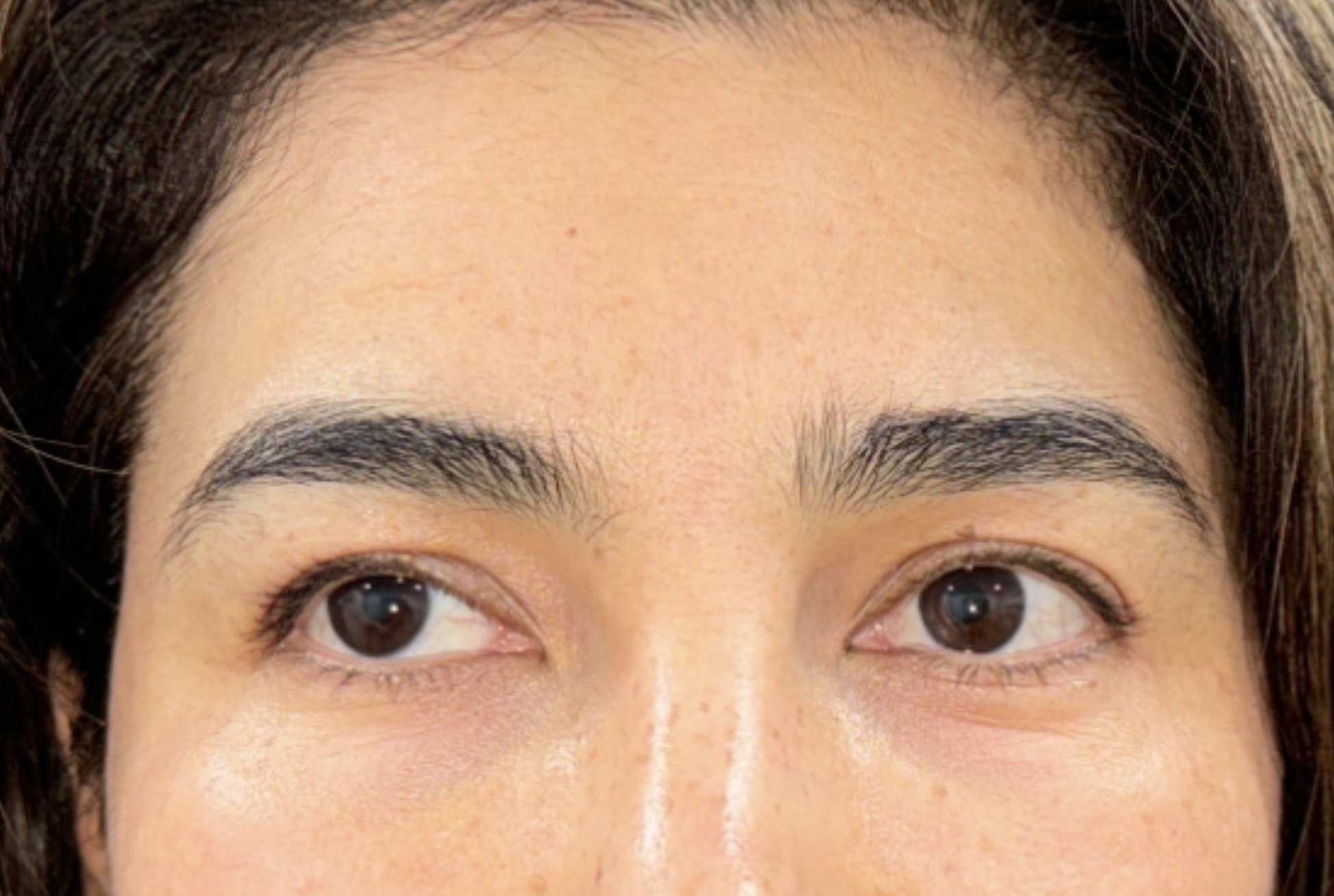 Before Image: Eyelid Surgery - front