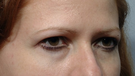 Before Image: Eyelid Surgery - right-front-oblique