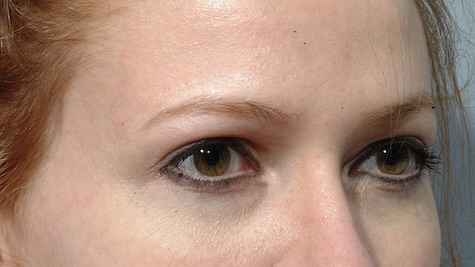 After Image: Eyelid Surgery - right-front-oblique