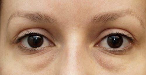 Before Image: Eyelid Surgery - front