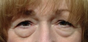 Before Image: Eyelid Surgery