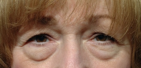 Before Image: Eyelid Surgery - front