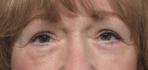 After Image: Eyelid Surgery