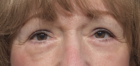 After Image: Eyelid Surgery - front