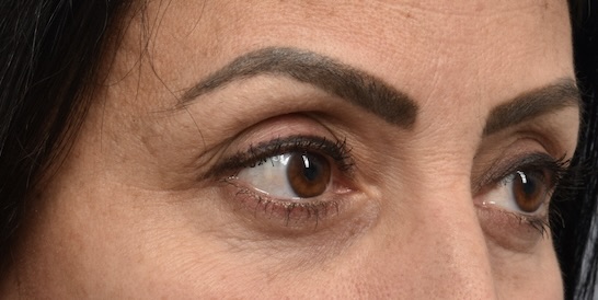 After Image: Eyelid Surgery - right-front-oblique