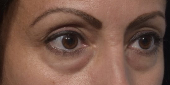 Before Image: Eyelid Surgery - right-front-oblique
