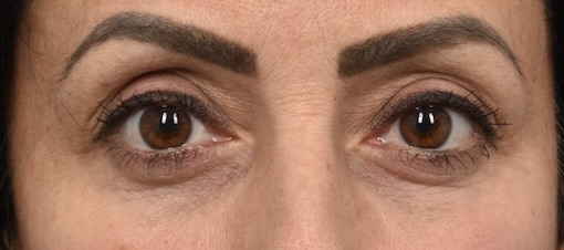 After Image: Eyelid Surgery - front