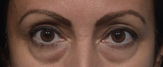 Before Image: Eyelid Surgery - front