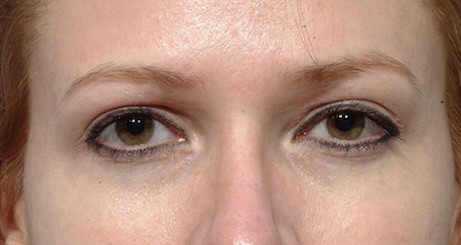 After Image: Eyelid Surgery - front