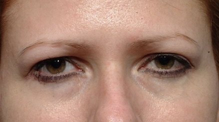 Before Image: Eyelid Surgery - front