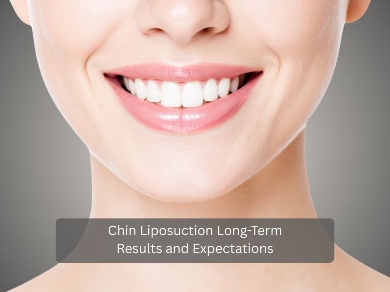 Chin Liposuction Long Term Results and Expectations Chin Liposuction Long Term Results and Expectations