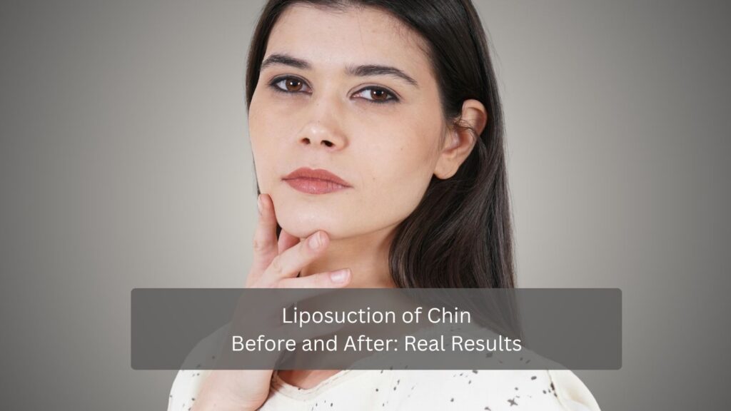 Liposuction of Chin Before and After Real Results