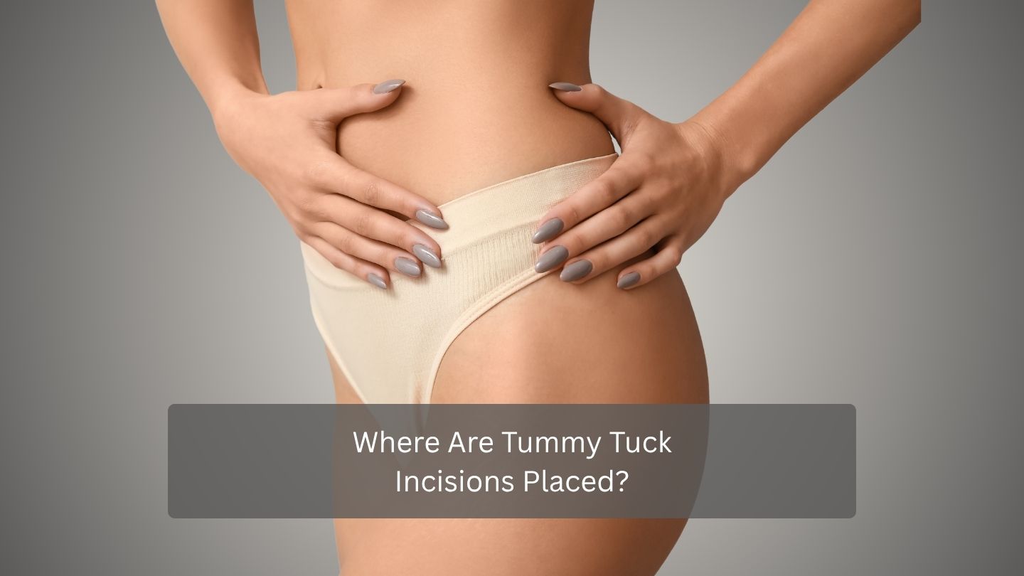 Where Are Tummy Tuck Incisions Placed